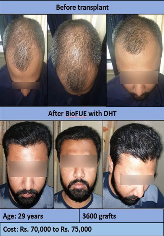 Gallery | Hair Transplant Clinic in Surat Gallery | Hair Transplant Clinic in Surat