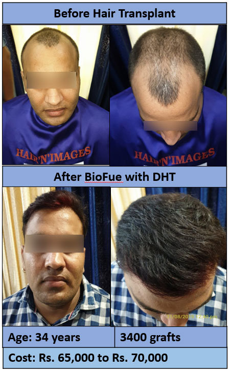 Bio FUE with DHT Bio FUE with DHT