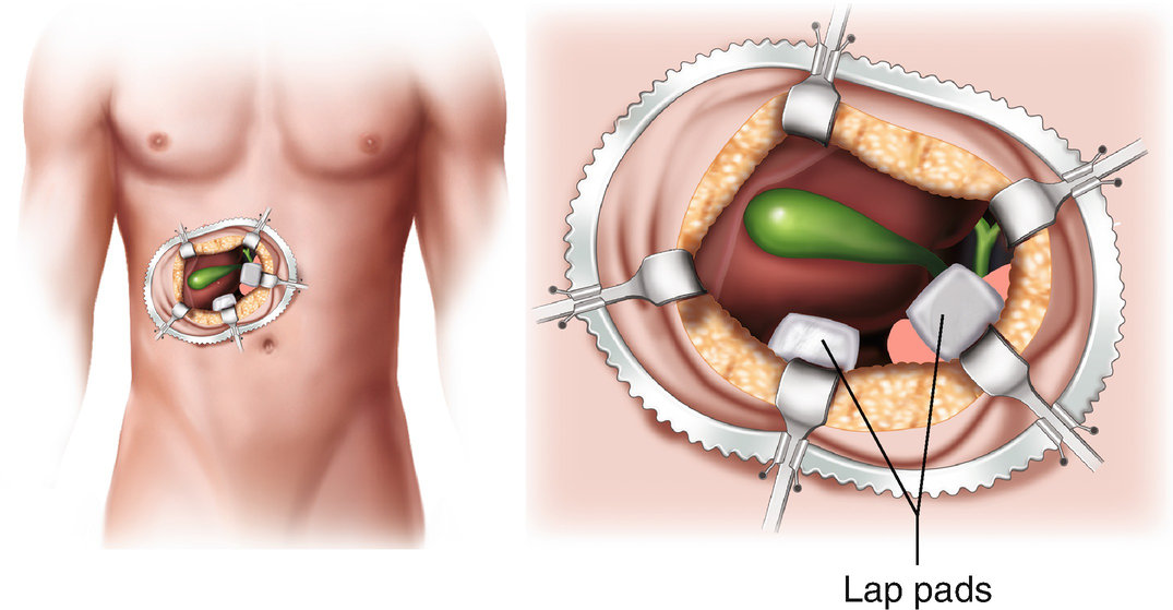 open cholecystectomy