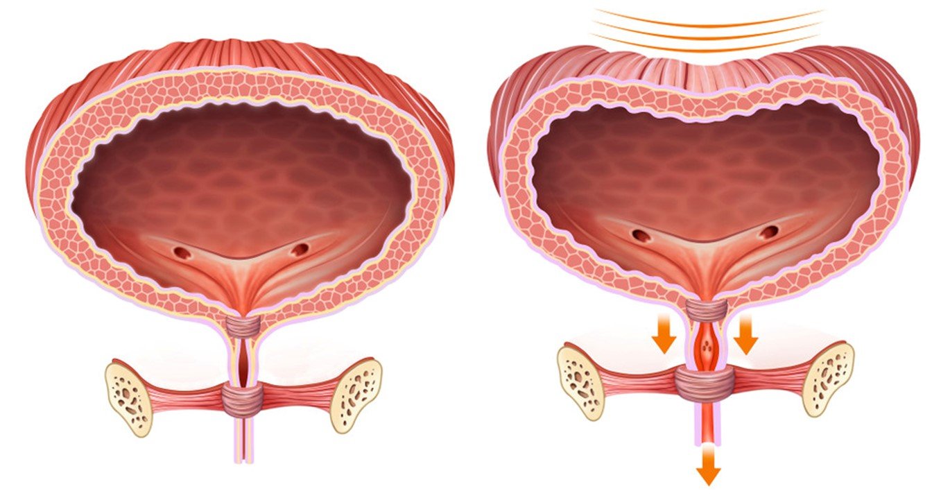 Urinary Incontinence Urinary Incontinence