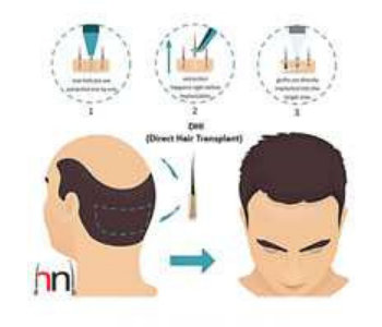 Best Hair Transplant Clinic in Surat  Hair N Images Clinic