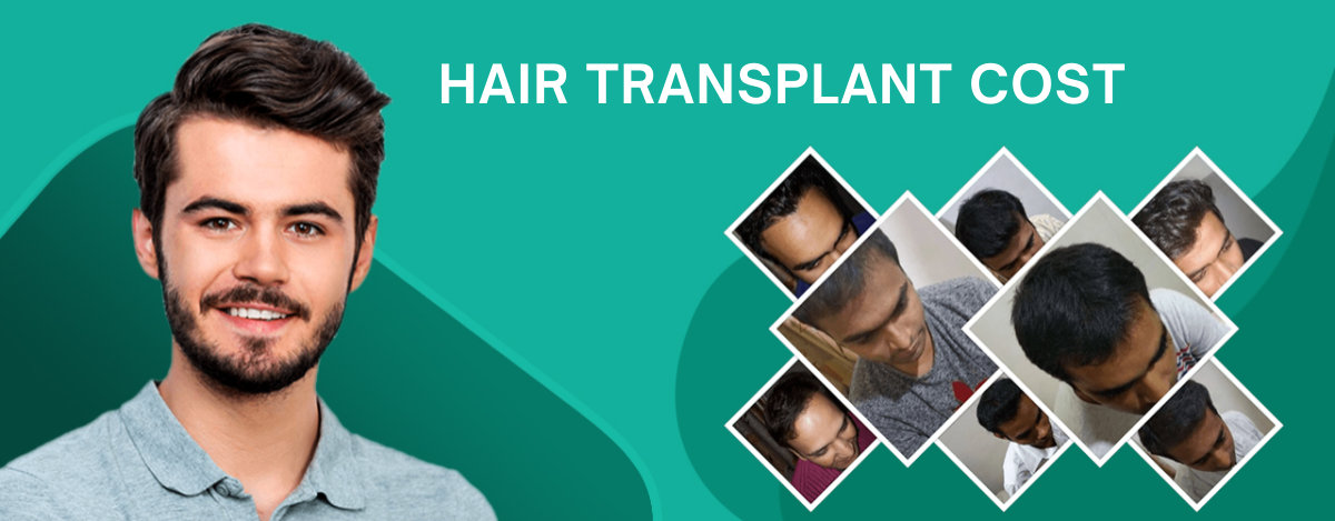 Hair Transplant Cost in Surat