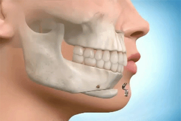 Độn cằm bằng xương tự thân là gì? Có an toàn và dễ thực hiện không?