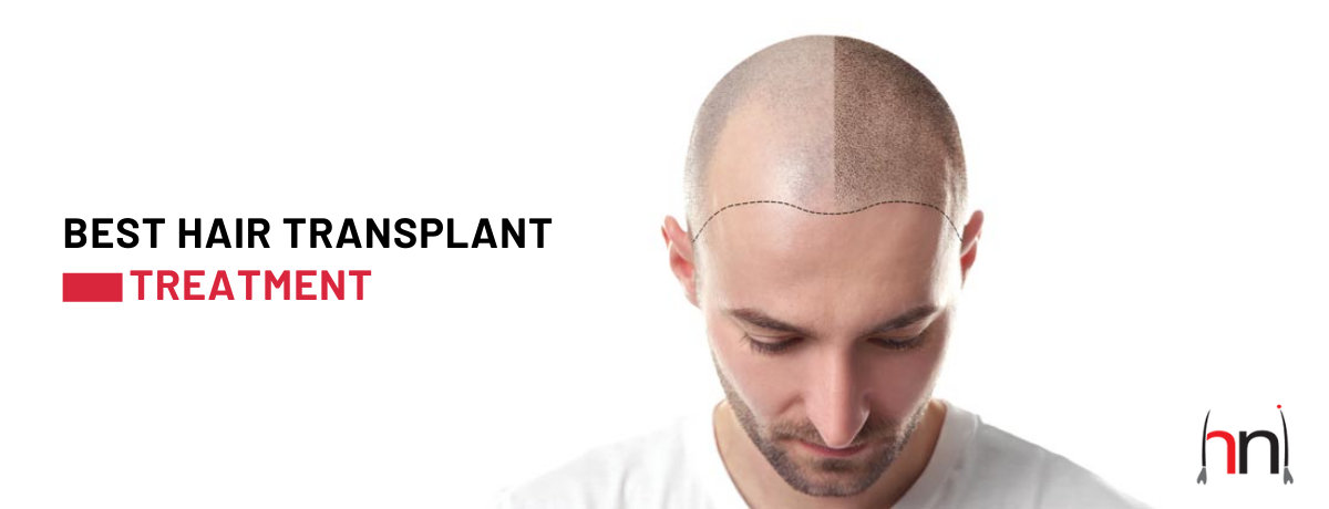 Hair Transplant in Surat