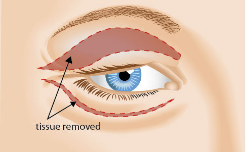 Eyelid Plastic Surgery Knoxville | Blepharoplasty Maryville |Drs. Campbell, Cunningham, Taylor, & Haun