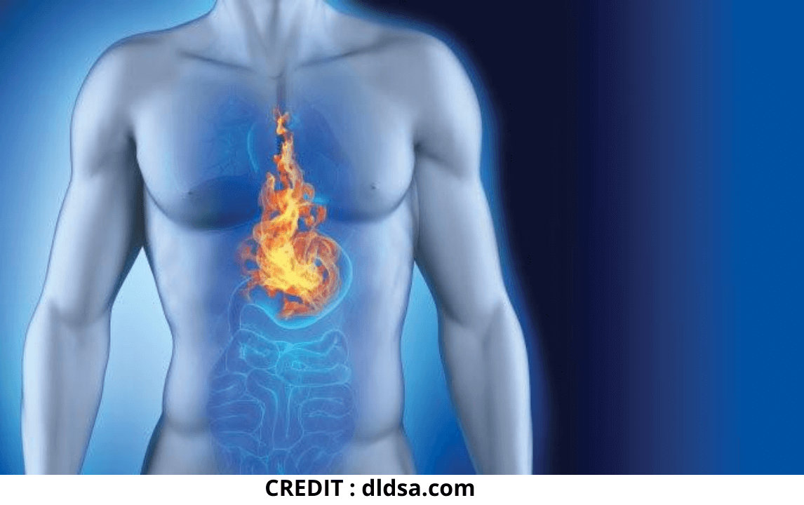 heartburn common in people