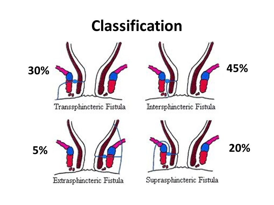 Fistula-in-ano: a probing of the treatment options - ppt video online  download