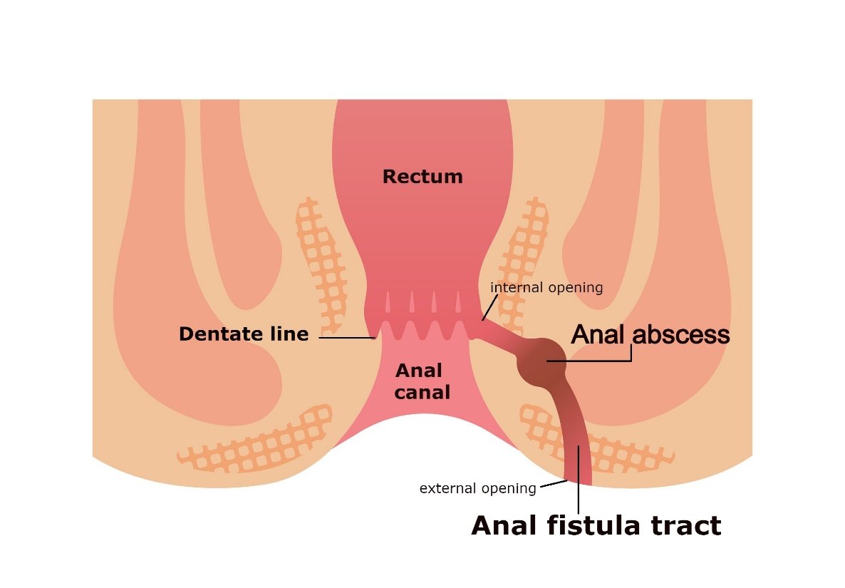 What is Anal Fistula? | Anal Fistula Treatment | WSM Medic