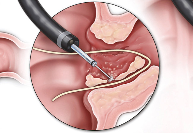 Novel Endoscopic Approach Opens New Fistula Treatment Possibilities in IBD  – Consult QD