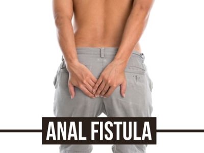 Anal Fistula: Causes, Risk Factors, Symptoms, Diagnosis, Treatments And Prevention - Boldsky.com
