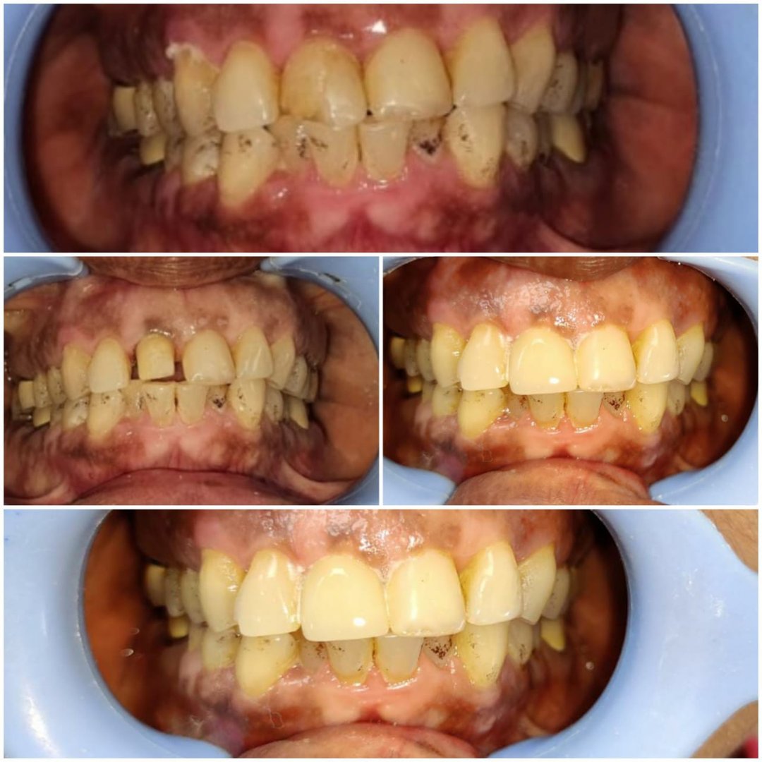 Teeth Cleaning in Noida - Neo Dental Care Teeth Cleaning in Noida - Neo Dental Care