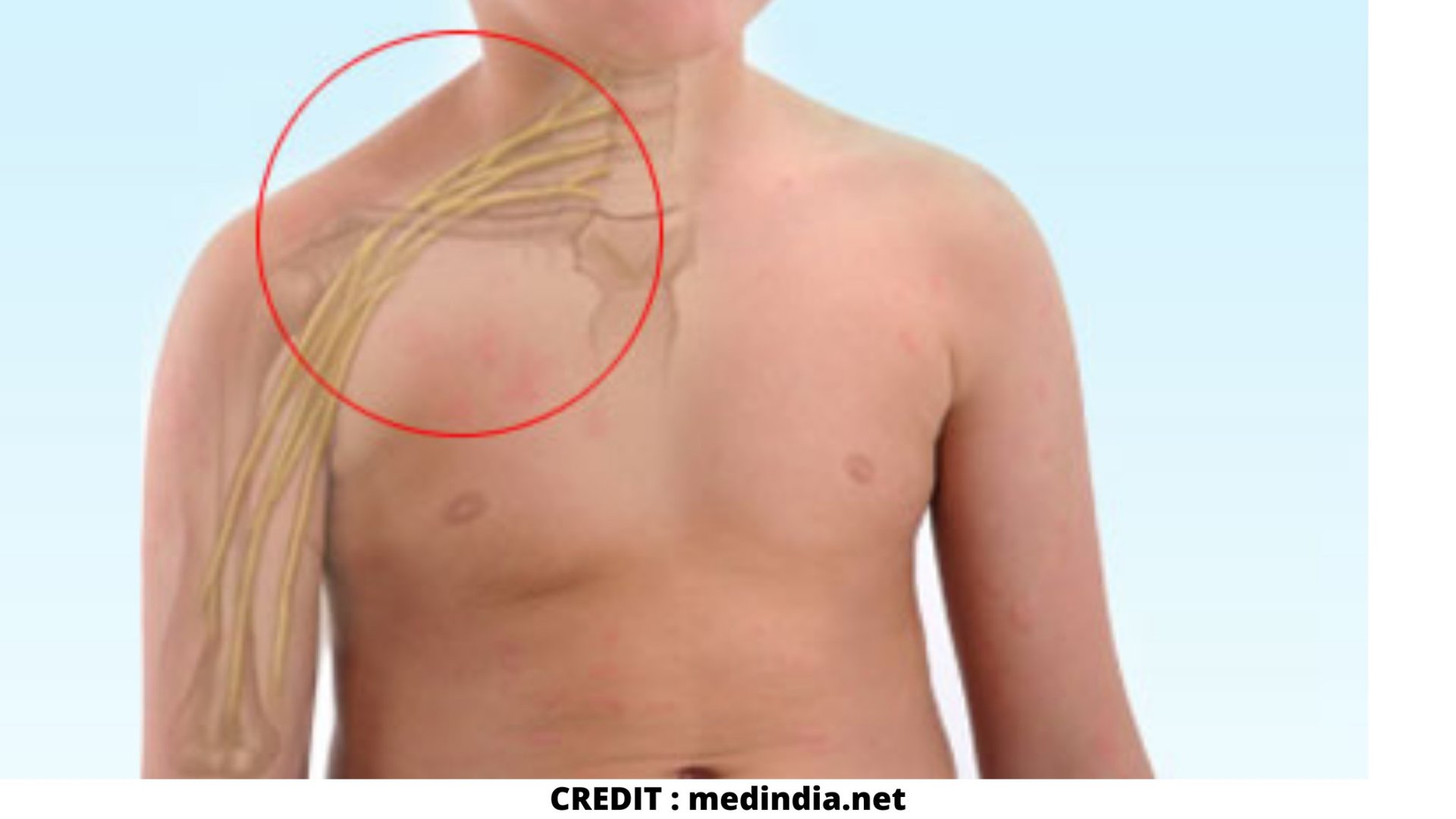 brachial plexus injury