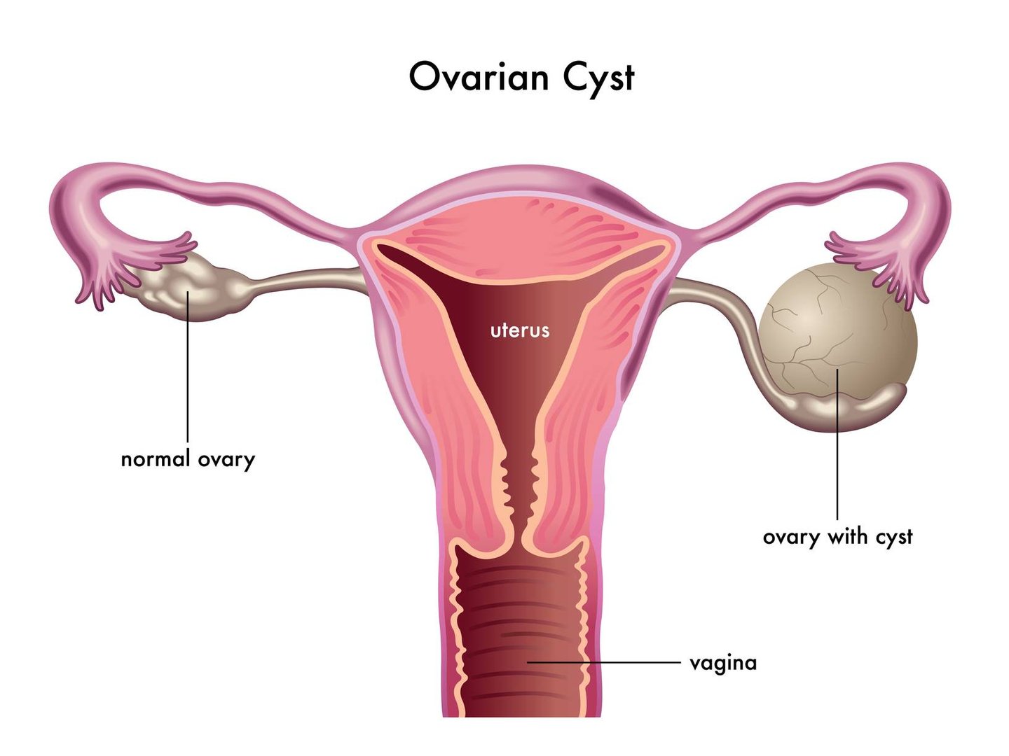 Ovarian Cysts Ovarian Cysts