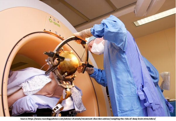 Procedure of DBS