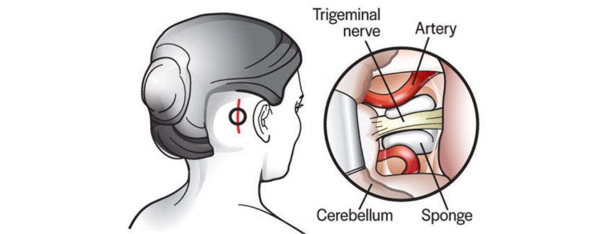Neurovascular Surgery Neurovascular Surgery