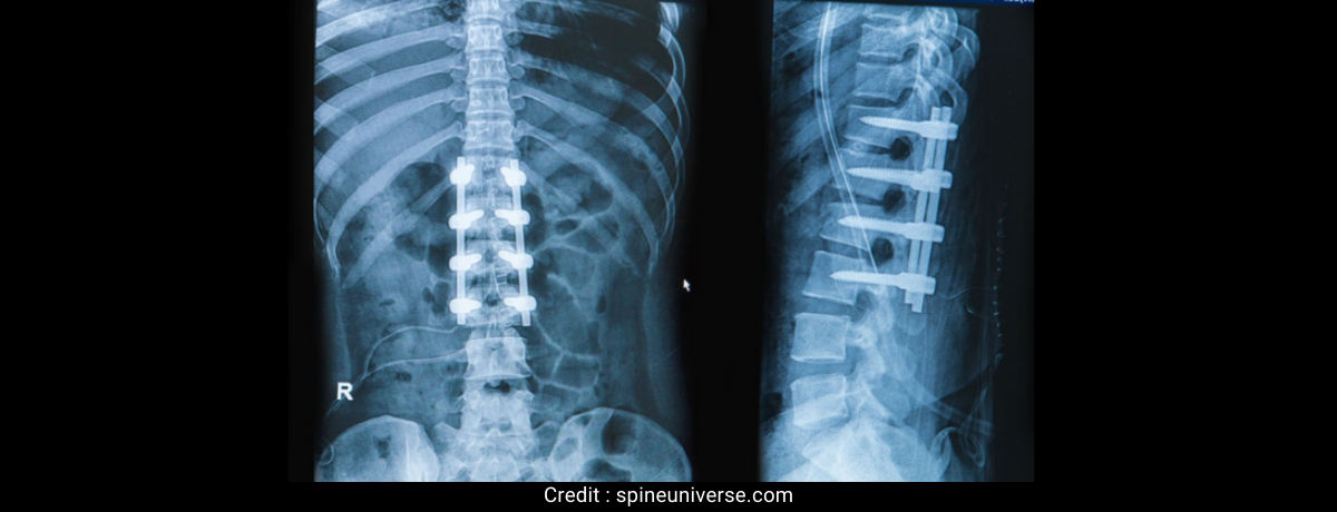 Does spinal fusion limit mobility