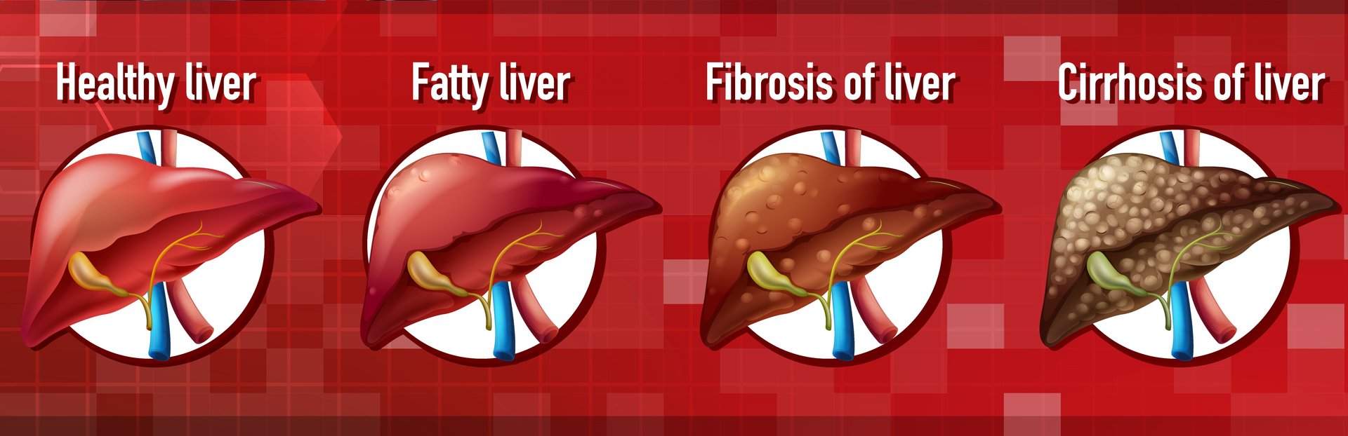 Liver Fibrosis Liver Fibrosis