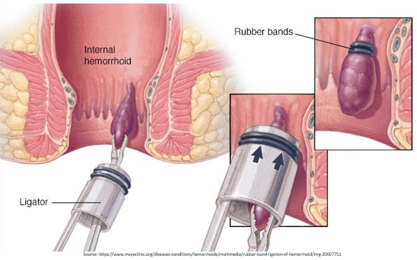 How are piles treated