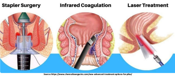 Hemorrhoidectomy