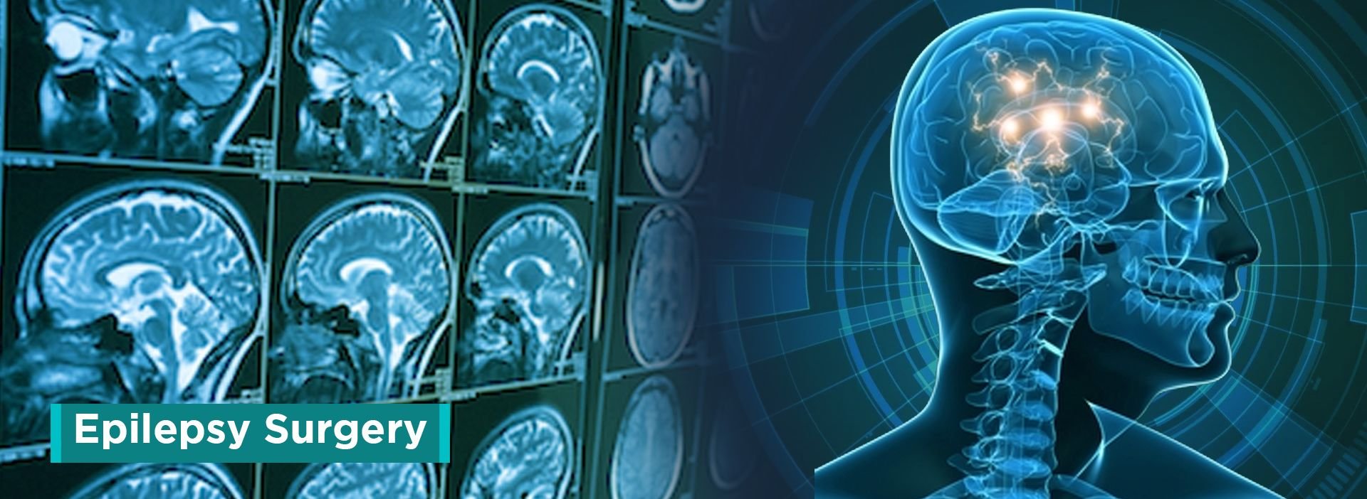 Top 4 Ways To Cure Epilepsy Top 4 Ways To Cure Epilepsy