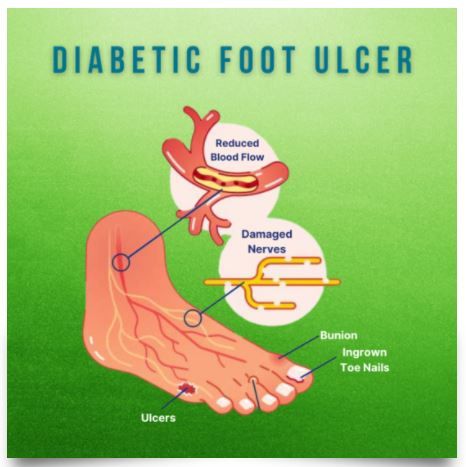 diabetic foot ulcer