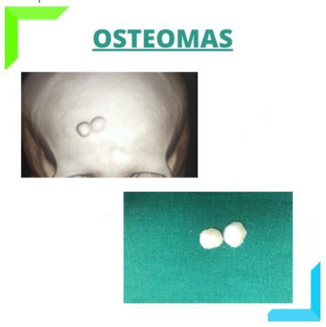 osteomas