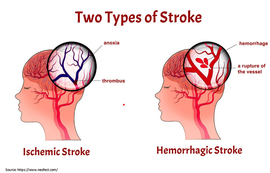 Ischemic attack with a transient onset