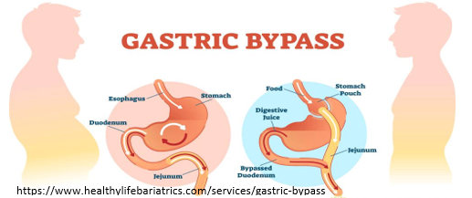 Gastric Bypass Surgery