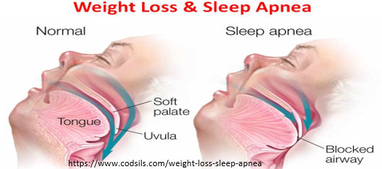Obesity and Obstructive Sleep Apnea