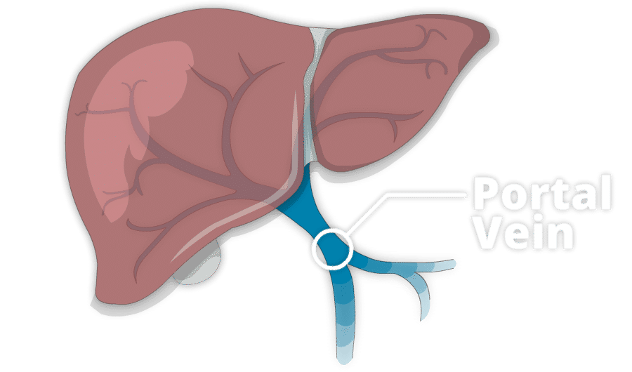Blood clots in the portal vein