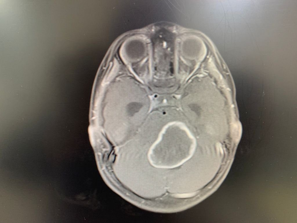 brain surgery image