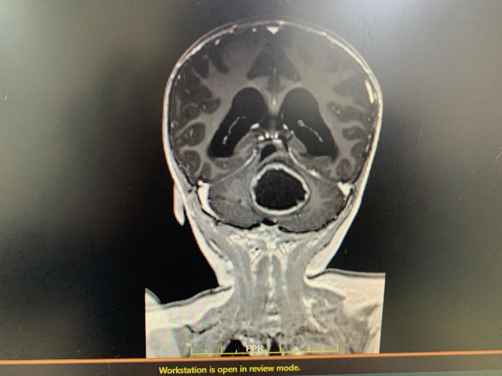 brain surgery image