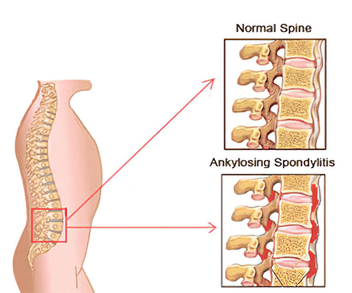 Ankylosing Spondylitis