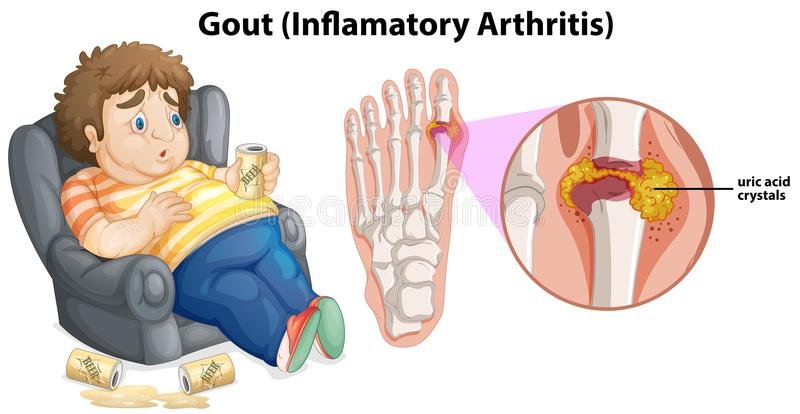 Gout