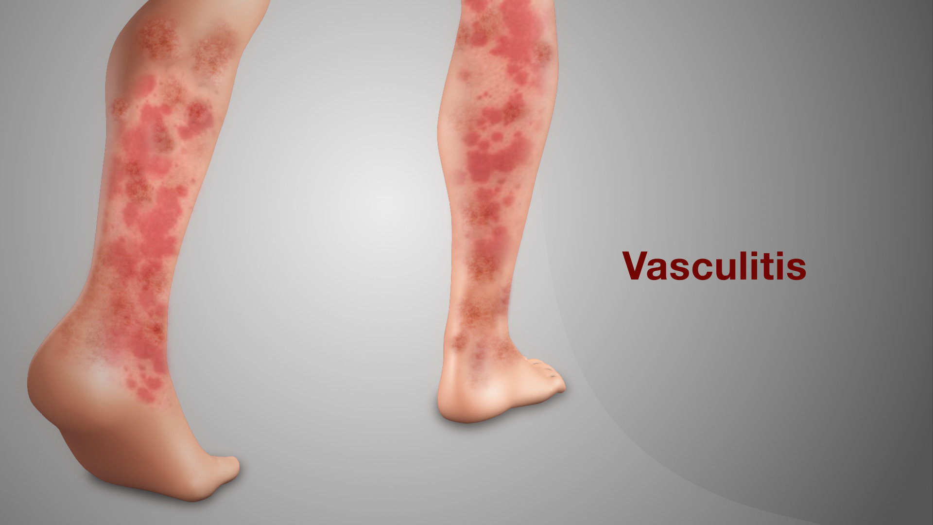 Vasculitis