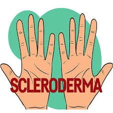 Scleroderma