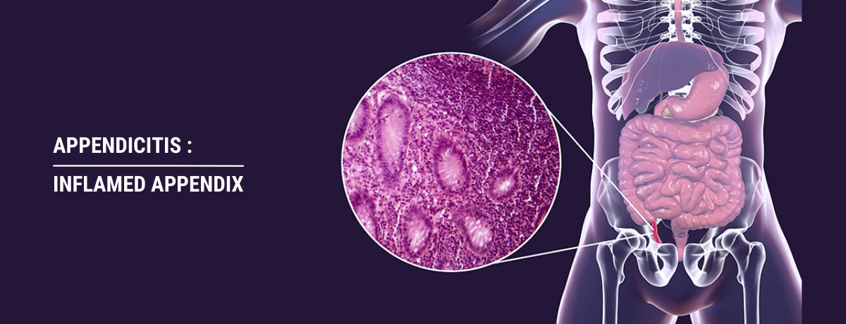 Appendicitis – Inflamed Appendix Appendicitis – Inflamed Appendix