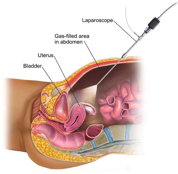 What is laparoscopic surgery