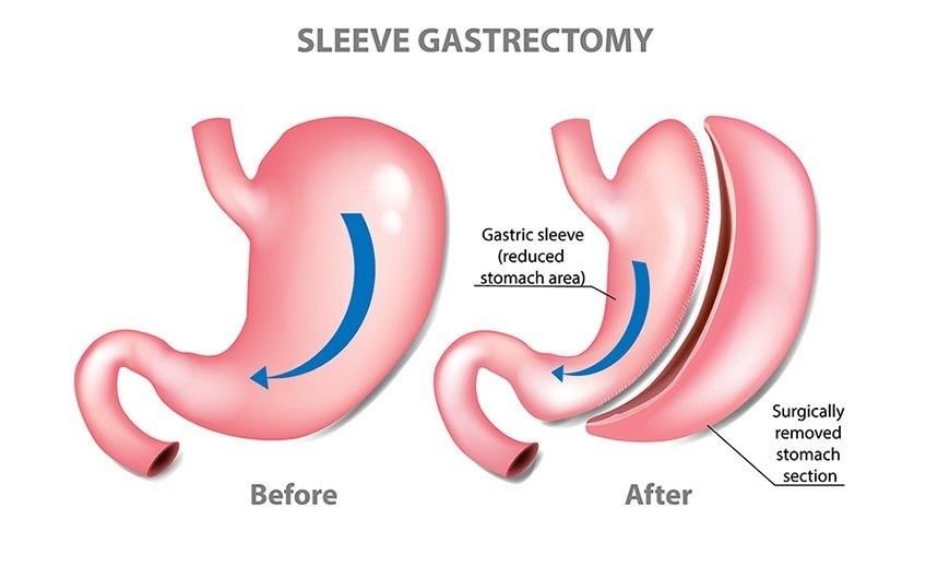 Laparoscopic Sleeve Gastrectomy