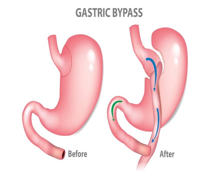 Laparoscopic Roux-en-Y Gastric Bypass