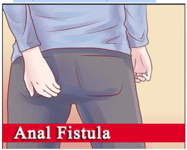 Anal Fistula Anal Fistula