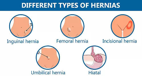 different types of hernia