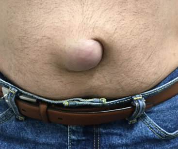 What is Hernia
