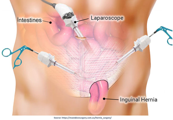 minimally invasive hernia surgery