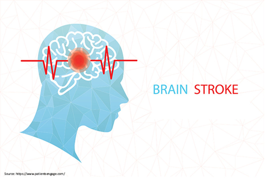 5 Things to Do In case of a Brain Stroke