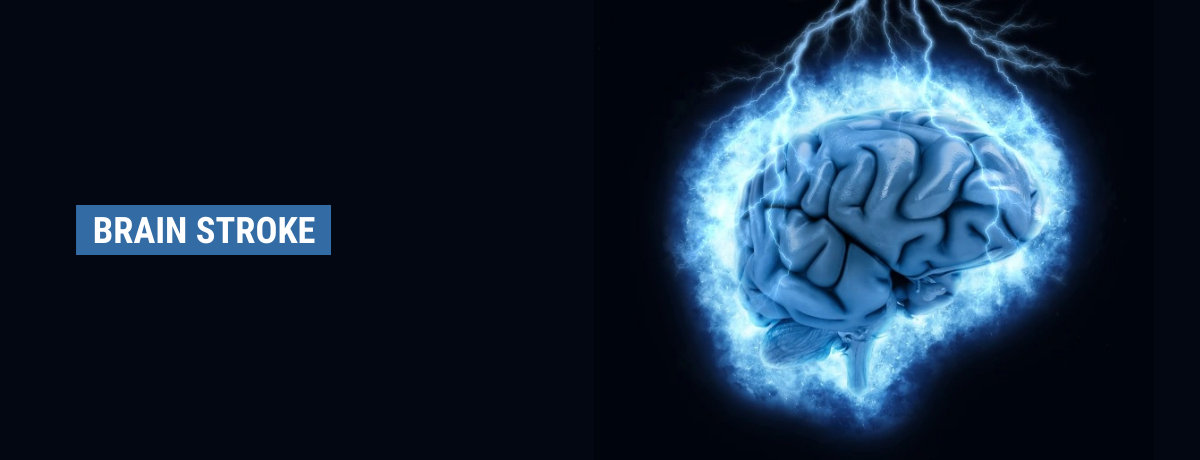Brain Stroke Brain Stroke