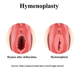 hymenoplasty