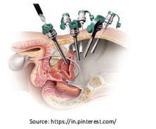 laparoscopic prostatectomy