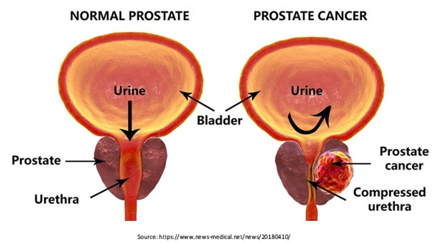 Prostate Cancer Treatment in Bangalore