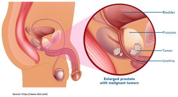 Prostate Cancer 